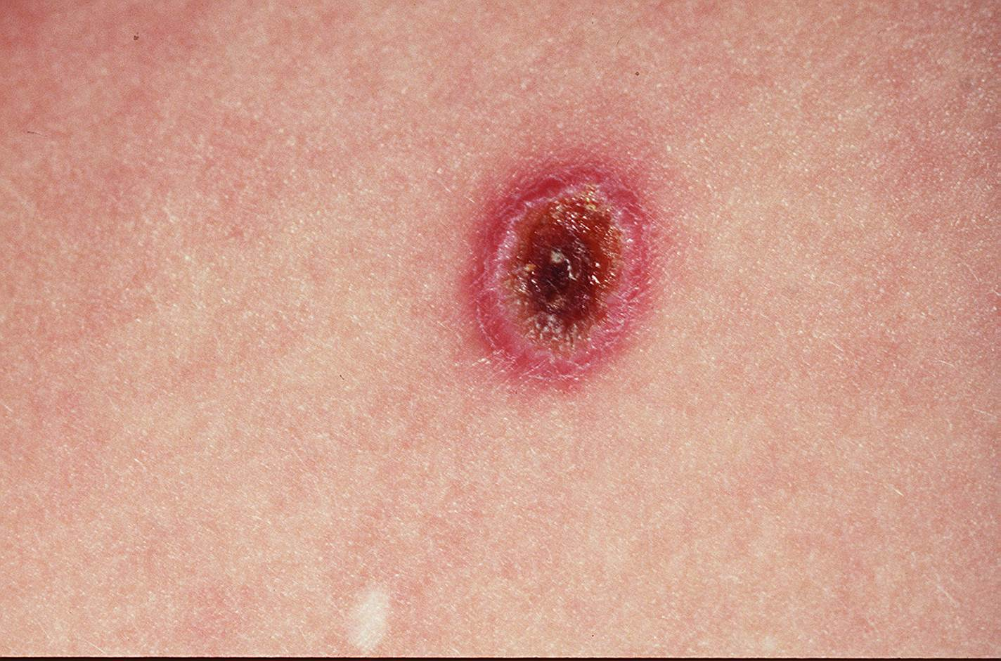 Scrub Typhus Eschar|right|200